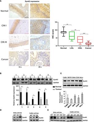 DYNLT3 overexpression induces apoptosis and inhibits cell growth and migration via inhibition of the Wnt pathway and EMT in cervical cancer